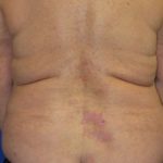 nivolumab-lichenoid-1__protectwyjqcm90zwn0il0_focusfillwzi5ncwymjisingildfd-1870514-1675587-jpg-9421725