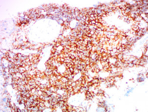 Tipo nasal de linfoma de células T asesino natural teñido con CD56 x200