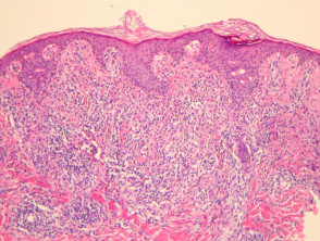 Linfoma extraganglionar de células NK / T, patología de tipo nasal