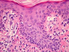 Extranodales NK / T-Zell-Lymphom, nasale Pathologie