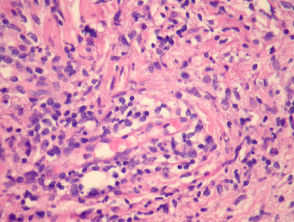 Linfoma extraganglionar de células NK / T, patología de tipo nasal