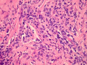 Extranodales NK / T-Zell-Lymphom, nasale Pathologie