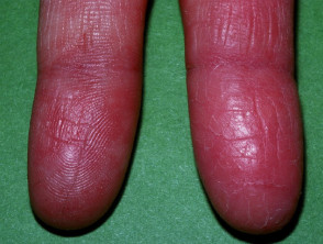 Huella dactilar reducida debido a dermatitis