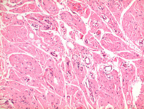 Patología primaria de la amiloidosis cutánea