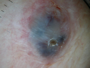 carcinoma nodular de células basales 1 dermatoscópico
