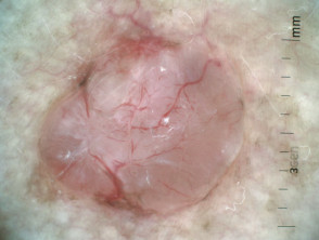 Carcinoma nodular de células basales 3 dermatoscópico