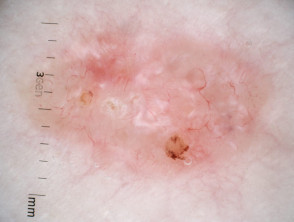 Dermatoscopia por carcinoma nodular de células basales no pigmentado
