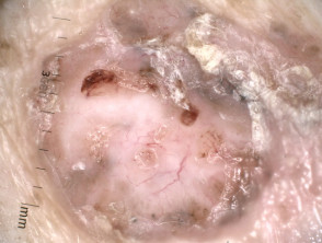 Knotige Basalzellkarzinom-Dermoskopie