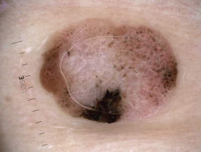 Melanoma nodular, Breslow 2,5 mm, vista de dermatoscopia polarizada
