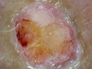 Dermatoscopia de melanoma nodular