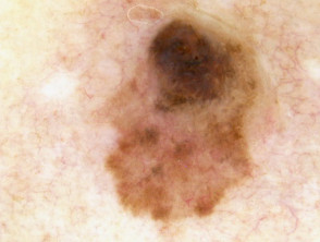 Dermatoscopia de melanoma nodular que surge dentro de un melanoma de extensión superficial