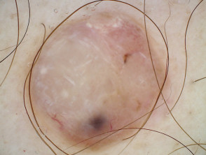 Melanoma nodular, Breslow 7,2 mm, vista de dermatoscopia polarizada