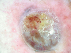 Dermatoscopia de melanoma nodular Breslow 4 mm
