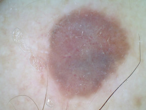 Dermatoscopia de melanoma nodular Breslow 4 mm