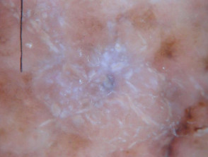 Un melanoma nodular que surge dentro de un melanoma de extensión superficial