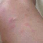 nodular-panniculitis-1__protectwyjqcm90zwn0il0_focusfillwzi5ncwymjisingildfd-1868558-6112521-jpg-5488398