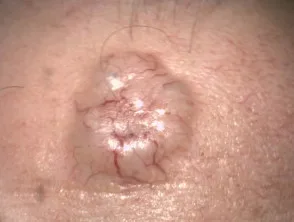 Carcinoma a cellule basali nodulocistico