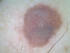 Vista de dermatoscopia no polarizada de melanoma amelanótico nodular