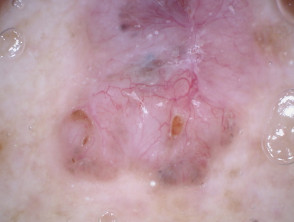 Dermoscopia non polarizzata del carcinoma basocellulare pigmentato