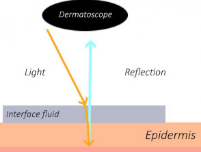Dermatoscopia no polarizada