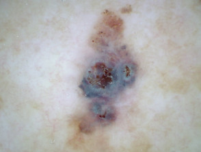 Niet-gepolariseerde dermoscopie van melanoom