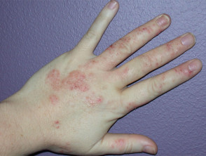 dermatitis de la mano