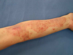 Dermatitis atópica grave adecuada para terapia sistémica