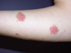 Dermatitis numular eccema discoide