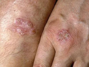 Dermatitis numular eccema discoide