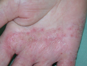 Dermatitis ocupacional de la mano