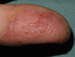 Dermatitis ocupacional de la mano