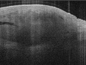 La tomografía de coherencia óptica