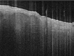 Tomografía de coherencia óptica: estructuras epidérmicas y dérmicas
