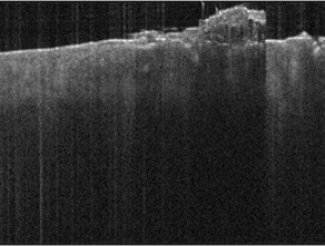 Tomografía de coherencia óptica: queratosis actínica