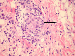 Patología de la granulomatosis orofacial