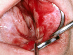 Liquen plano oral ulcerativo