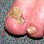 onychogryphosis-04__protectwyjqcm90zwn0il0_focusfillwzi5ncwymjisingildfd-6315638-4200295-jpg-3662827
