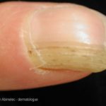 onychomatricoma__protectwyjqcm90zwn0il0_focusfillwzi5ncwymjisingildfd-2682420-4977232-jpg-7319685