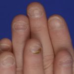 onychophagia-1__protectwyjqcm90zwn0il0_focusfillwzi5ncwymjisingildfd-7463720-5114568-jpg-4367172