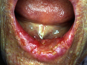 Cancro orale