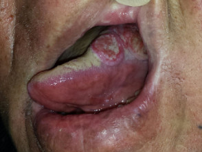 Carcinoma de lengua