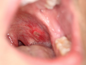 Enfermedad de Crohn oral