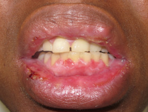 Eritema multiforme oral