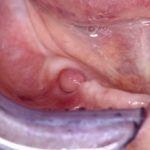 oral-fibroma__protectwyjqcm90zwn0il0_focusfillwzi5ncwymjisingilde5xq-8582767-3765080-jpg-9109730