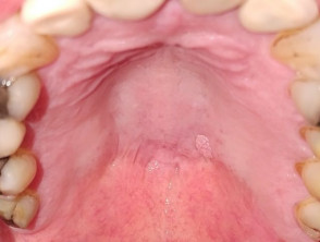 Papiloma oral de células escamosas