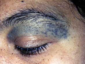 Nevus de Ota