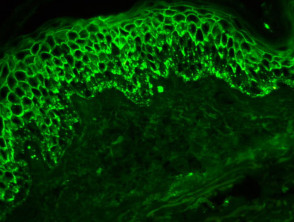 Pénfigo foliáceo - inmunofluorescencia directa