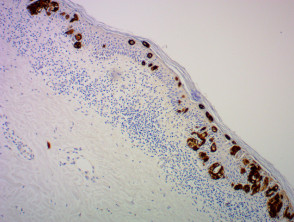CK7 + en infiltración Pagetoidea de la epidermis por cáncer de mama
