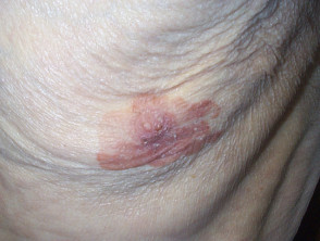 Enfermedad de Paget mamaria de la piel en un hombre