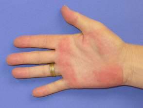 palmar-erythema02__protectwyjqcm90zwn0il0_focusfillwzi5ncwymjisingildfd-7793802-8452483-jpg-7116030